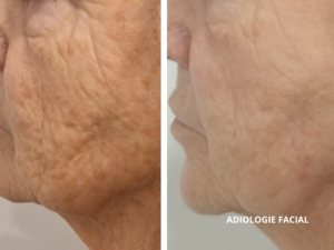 resultados-adipologie-facial-valencia