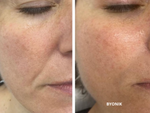resultados-byonik-facial-valencia
