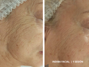 resultados-indiba-facial-valencia