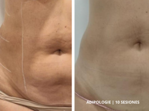 antes-despues-adipologie-corporal-valencia